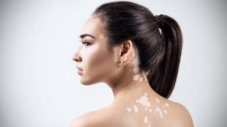 Día Mundial del Vitiligo